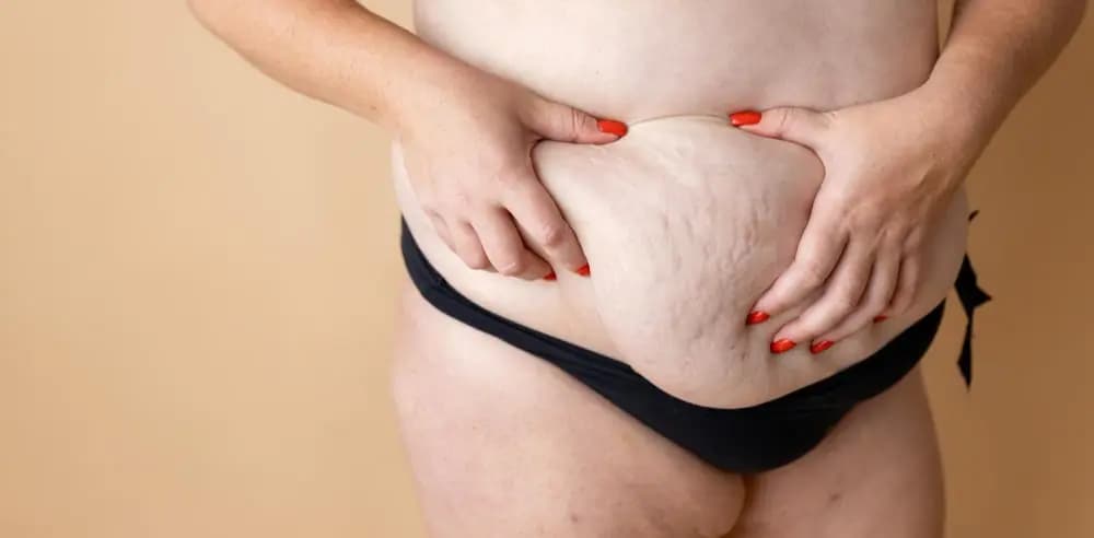 best oils for stretch marks